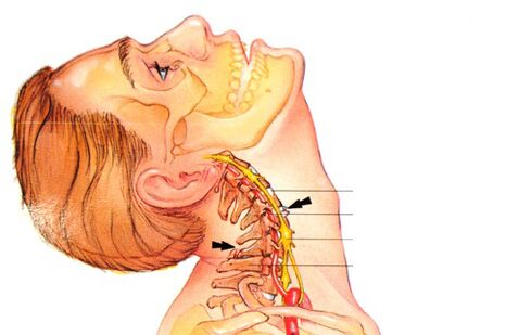 nyaki osteochondrozis tünetek kenőcskezelés